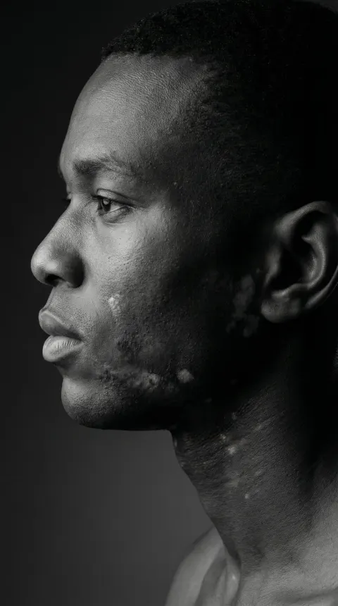 Vitiligo Side Profile Studio Portrait
