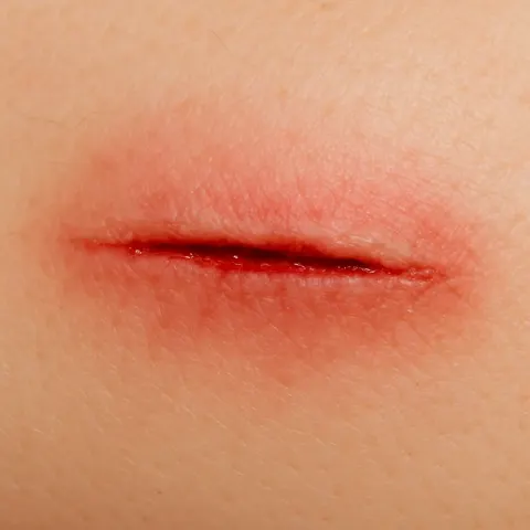 Visible Wound on Human Skin Characterized by Red Coloration