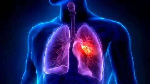 Lung Cancer