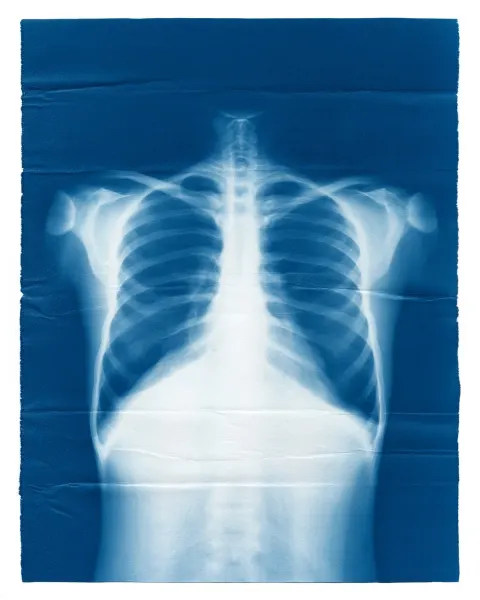 X-ray image of a human torso rendered as an abstract cyanotype-style image